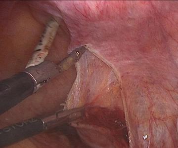 Eröffnen des Retroperitonums