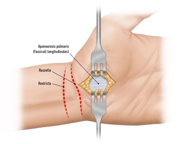 Planung/Hautinzision 1