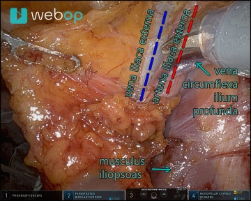 Lymphondektomie im Bereich der Arteria und vena iliaca externa