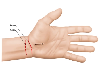 Spülung und Hautnaht 1