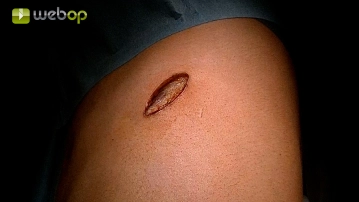 Zugang Uniportale VATS und extrapleurale Präparation