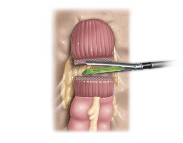 507_10 Durchtrennung Rectum_grün.jpg