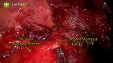 Präparation der Pulmonalarterie