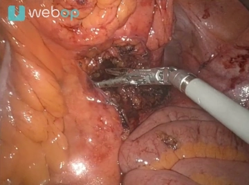 Tubuläre Durchtrennung des Sigmamesos