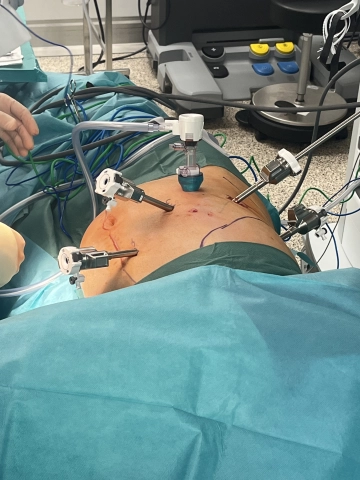Anlage Pneumoperitoneum, Trokarpositionierung und Docking 1