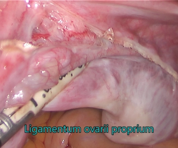 Vaskuläres Mesometrium und Ligamentum latum rechts 1
