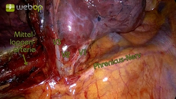 Präparation der Segment-3-Vene