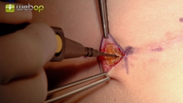 Präparation der Eintrittspforten