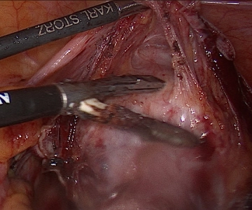 Präparation der Harnblase