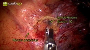 Hiläre Präparation