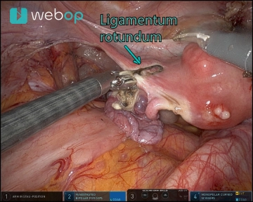 Adnexektomie, Vaskuläres Mesometrium und Ligamentum latum links