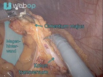 En bloc Omentektomie