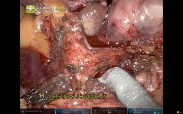 513 7 Gasrroduodenalis.jpg