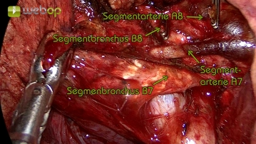 Präparation und Absetzen der Segmentarterie A7