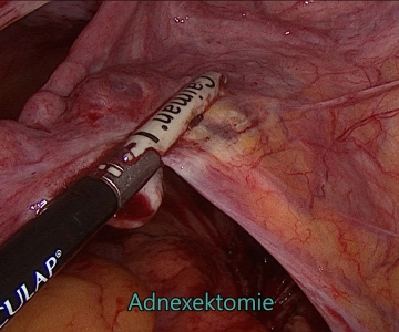 Adnexektomie und parametraner Halteapparat rechts 1