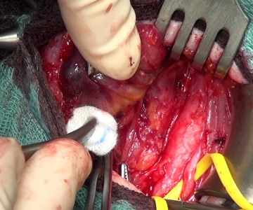 Visuelle Darstellung des Nervus laryngeus recurrens bis zum Kehlkopf