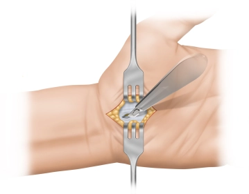Durchtrennung Palmaraponeurose 1