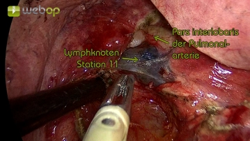 Präparation des Interlobiums