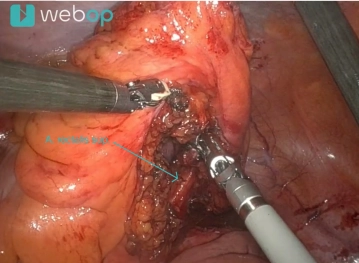 Präparation des rectosigmoidalen Übergangs