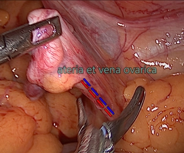 Ligamentum infundibulopelvicum rechts