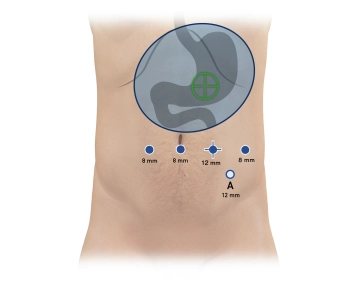 514_Trokarpositionen Kopie 3 als 12 mm.jpg