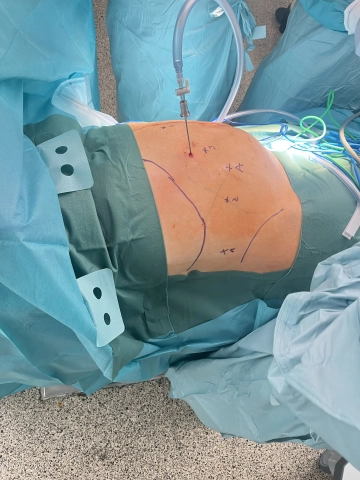 Anlage Pneumoperitoneum, Trokarpositionierung und Docking 2
