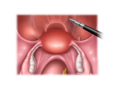 Adnexektomie und parametraner Halteapparat rechts 3
