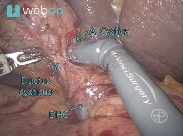 514_07 Cholezystektomie.jpg