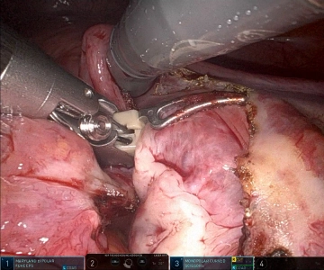 Ligamentum ovarii proprium rechts