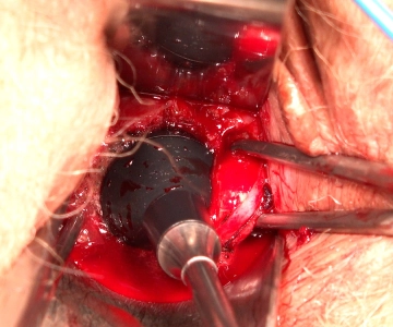 Thermokoagulation des Konisationskraters