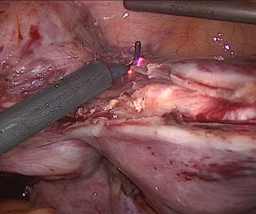 Absetzen des Corpus uteri