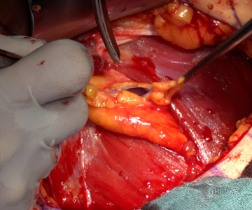 Eröffnung Peritoneum