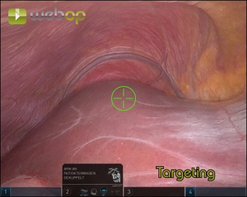 Neumoperitoneo, colocación de trocares y acoplamiento 3