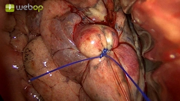 Identifikation und Markierung des Tumors
