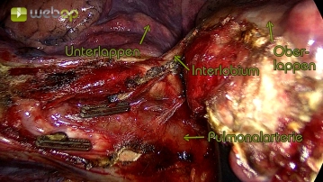 Präparation der Pars interlobaris der Pulmonalarterie