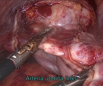 Adnexektomie und parametraner Halteapparat links 1