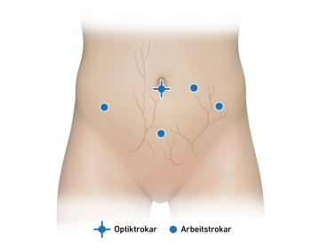 Arbeitstrokare und Inspektion des kleinen Beckens 1