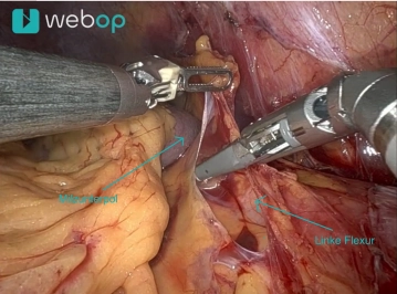 Mobilisation der linken Flexur