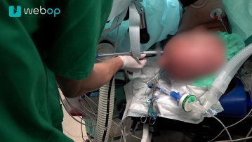 VAC-Stent Platzierung und Freisetzung