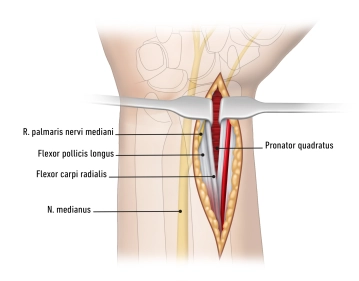 Zugang modifiziert nach Henry