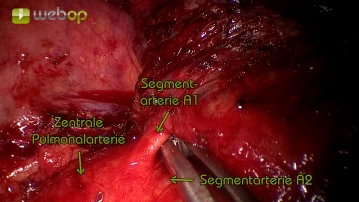 Dissektion der Segmentarterien A1 bis A3