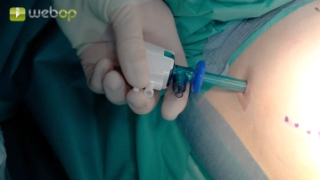 Einbringen des Optik-Trokars