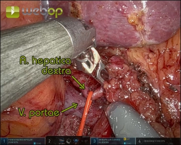 Preparación del hilio