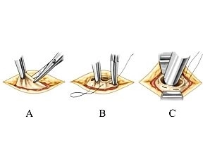 Mini-Laparotomie und Anlegen des Pneumoperitoneums