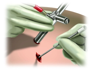 Platzierung der Einführhilfe