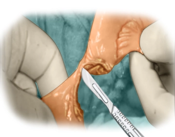 Resektion des Darmabschnittes