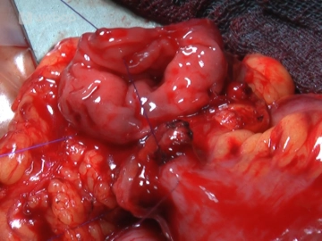 Darmnaht 1 (Legen der Haltefäden)