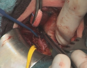 Exploration der unteren Nebenschilddrüse im normalen Lokalisationsbereich