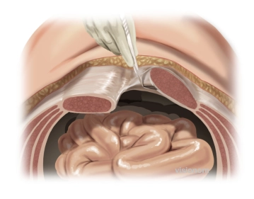 Inzision der hinteren Rektusscheide