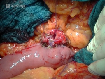 Retrocolische End-zu-Seit Pancreatico-Jejunostomie